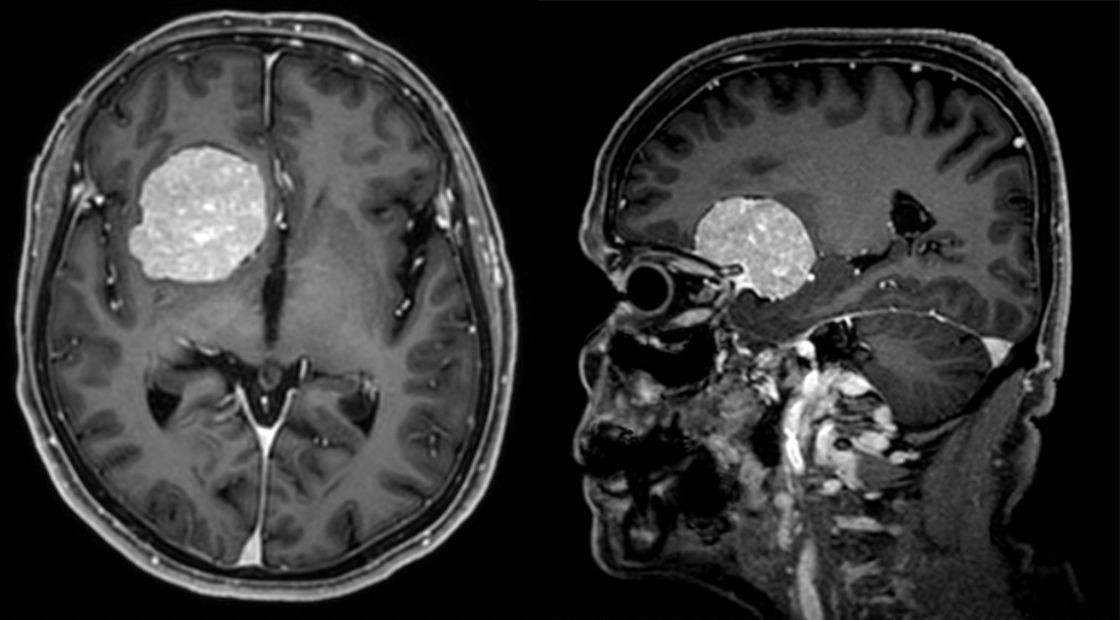 KI für Hirntumor-Erkennung